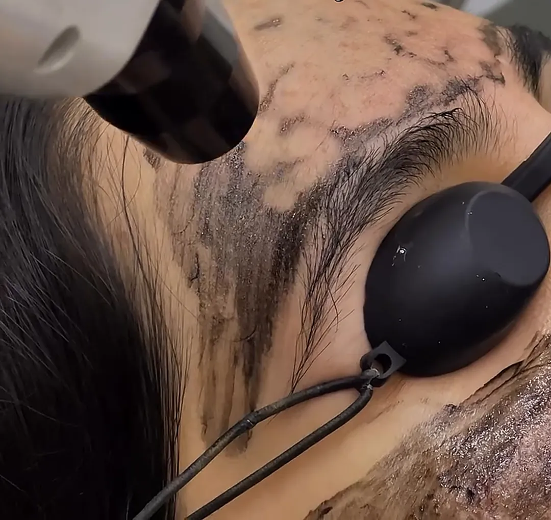 Carbon Laser Facial at Refine Aesthetics