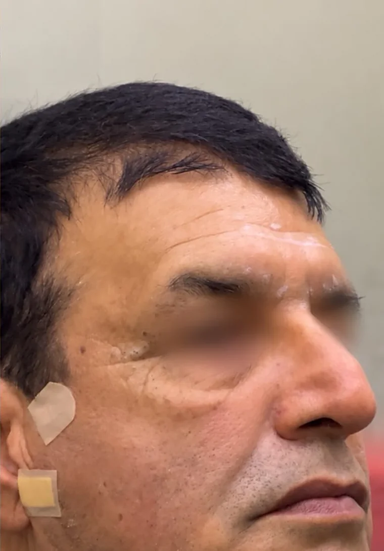 Thread Lift at Refine Aesthetics