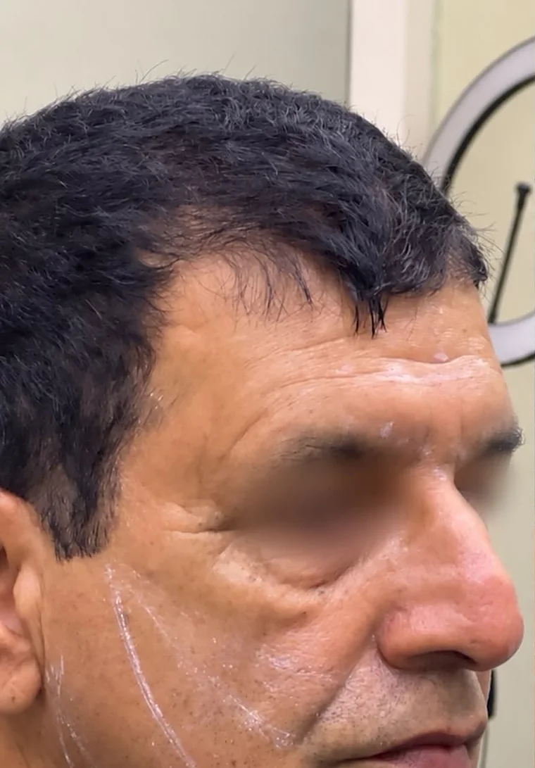 Before thread lift